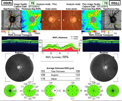 optical coherence tomography thickness measurements|optical coherence tomography test results.